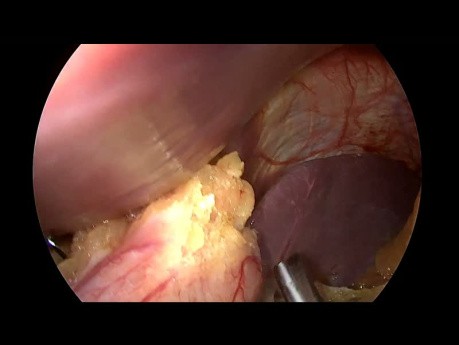 Chirurgie Nissen - Focus sur la Dissection et la Mobilisation