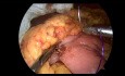 Anastomose gastro-jéjunale laparoscopique 3 trocarts avec entéro-entérostomie de Braun