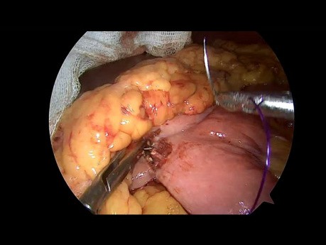 Anastomose gastro-jéjunale laparoscopique 3 trocarts avec entéro-entérostomie de Braun