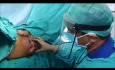 Perte de contrôle du sphincter pendant une opération de fistule anale - colostomie temporaire ou permanente