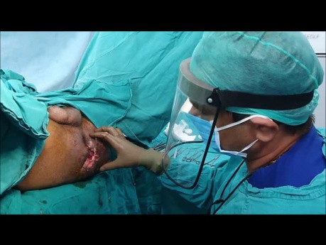 Perte de contrôle du sphincter pendant une opération de fistule anale - colostomie temporaire ou permanente