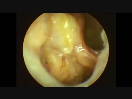 Examen endoscopique d'une cavité mastoïde après une chirurgie du cholestéatome congénital