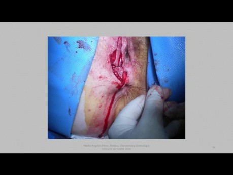 Tumeur de la vulve à cellules granuleuses - l'exérèse et la fermeture en utilisant une greffe cutanée (transplantation d'îles)