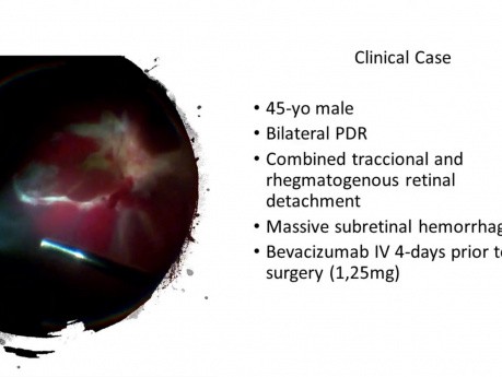 Hémorragie sous-rétinienne masive et décollement rétinien combiné de PDR