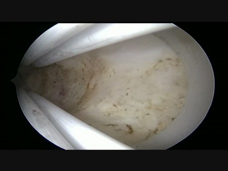 Fibrome Sous-Muqueux, Résectoscope Opératoire