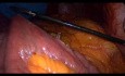 Bypass gastrique par voie cœlioscopique - partie 2