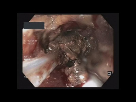 Nécrosectomie pancréatique endoscopique directe
