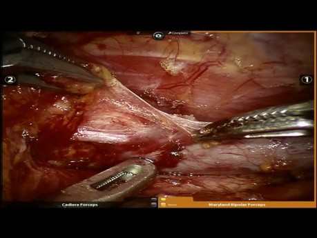 L'exérèse de l'adénome parathyroïdien robot-assistée