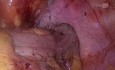 Sigmoïdectomie Laparoscopique avec Métastasectomie Hépatique