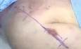 Approche Orthopédique - Approche Delto-Pectorale de l'Epaule | Académie Orthopédique