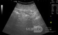 Abcès appendiculaire -  L'échographie 1