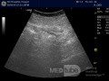 Abcès appendiculaire -  L'échographie 1
