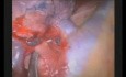 Lobectomie Supérieure Droite et Segmentectomie Pulmonaire par Vidéo-Thoracoscopie Uniportale