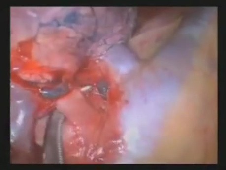 Lobectomie Supérieure Droite et Segmentectomie Pulmonaire par Vidéo-Thoracoscopie Uniportale