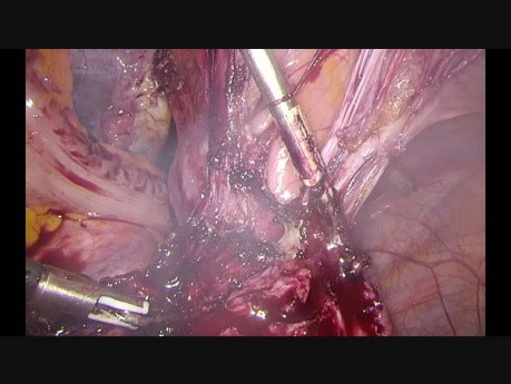 Hystérectomie laparoscopique. La patiente après 3 césariennes.
