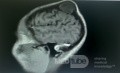 Tumeur Cérébrale