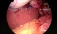 Cholécystectomie laparoscopique par incision unique (SILS)