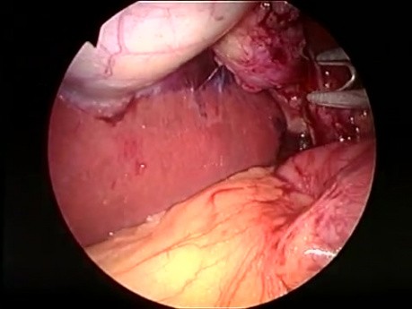 Cholécystectomie laparoscopique par incision unique (SILS)