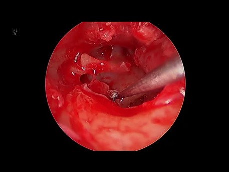 Tympanoplastie Endoscopique de Type 3 PORP 3