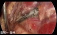 Chirurgie Thyroïdienne Endoscopique Trans-Sous-Clavière à Double Abord (partie 5)