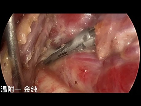 Chirurgie Thyroïdienne Endoscopique Trans-Sous-Clavière à Double Abord (partie 5)