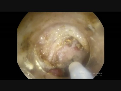 Myotomie per-oral endoscopique (POEM) apres la dilatation endoscopique de l'œsophage