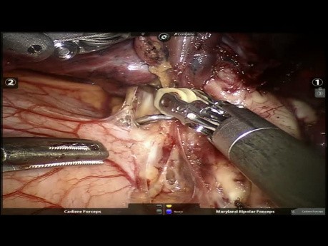 Cancer du poumon - VAMLA et lobectomie supérieure gauche assistée par robot