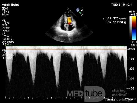 Cardiomyopathie hypertrophique obstructive.