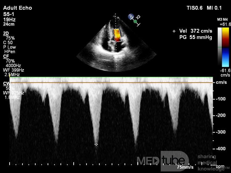 Cardiomyopathie hypertrophique obstructive.