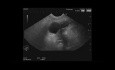 Écho-endoscopie d'une tumeur intracanalaire papillaire et mucineuse du pancréas (TIPMP)
