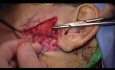 Abords transparotidiens préauriculaires dans les fractures mandibulaires extra-condiliennes bilatérales.