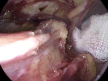 Anatomie Inguinale dans la Réparation de Hernie TAPP