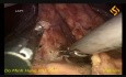 Gastrectomie distale par voie laparoscopique avec curage ganglionnaire D2