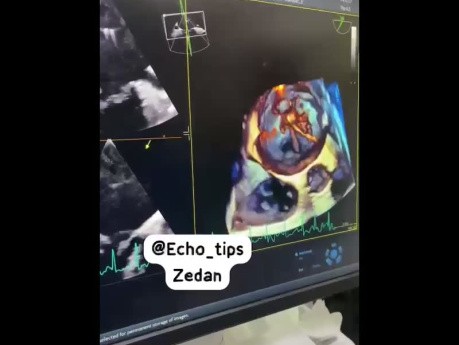 Échocardiographie Transœsophagienne 3D dans la Valvuloplastie Mitrale Percutanée par Ballonnet