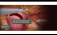 Animation de Myomectomie Laparoscopique Fermeture à 3 Couches avec Sutures à Barbes Bidirectionnelles Quill®