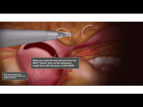 Animation de Myomectomie Laparoscopique Fermeture à 3 Couches avec Sutures à Barbes Bidirectionnelles Quill®