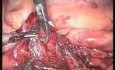 Appendicectomie laparoscopique