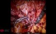 Réparation Robotique d'une Hernie de la Paroi Abdominale Traumatique