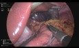 Bypass Gastrique Laparoscopique à Anastomose Unique avec Réparation d'une Hernie Hiatale et Cholécystectomie