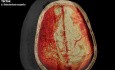 Craniotomie Ostéoplastique dans un Cas d'Hématome Sous-Dural Aigu Spontané 