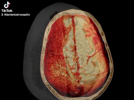 Craniotomie Ostéoplastique dans un Cas d'Hématome Sous-Dural Aigu Spontané 