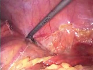 Hémicolectomie gauche par laparoscopie pour une tumeur du côlon