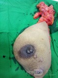 un tumeur maligne du sein après chimioradiothérapie néoadjuvante