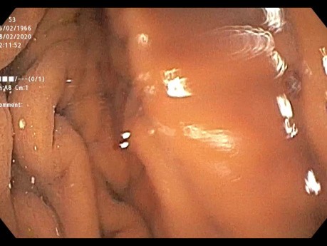 L'insertion d'une endoprothèse œsophagienne.
