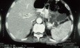 Le cancer du pancréas - 1