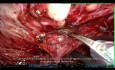 Astuces: Prostatectomie Radicale Robot-Assistée