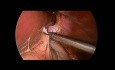 Réintervention laparoscopique en raison d'une hernie hiatale récidivante - mise en place d'un treillis synthétique