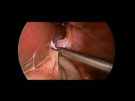 Réintervention laparoscopique en raison d'une hernie hiatale récidivante - mise en place d'un treillis synthétique