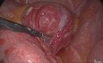 Résection cunéiforme laparoscopique pour une tumeur stromale jéjunale 