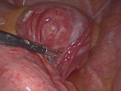 Résection cunéiforme laparoscopique pour une tumeur stromale jéjunale 